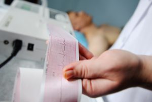 ECG