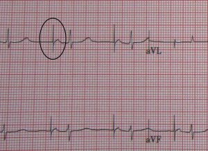 Pacemaker