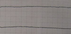 asystole