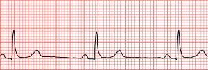 bradycardia